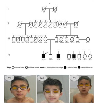 A Novel Homozygous Frameshift Variant in XYLT2 Causes Spondyloocular Syndrome in a Consanguineous Pakistani Family